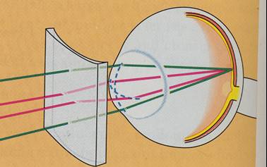 Korekce astigmatizmu cylindrickou čočkou